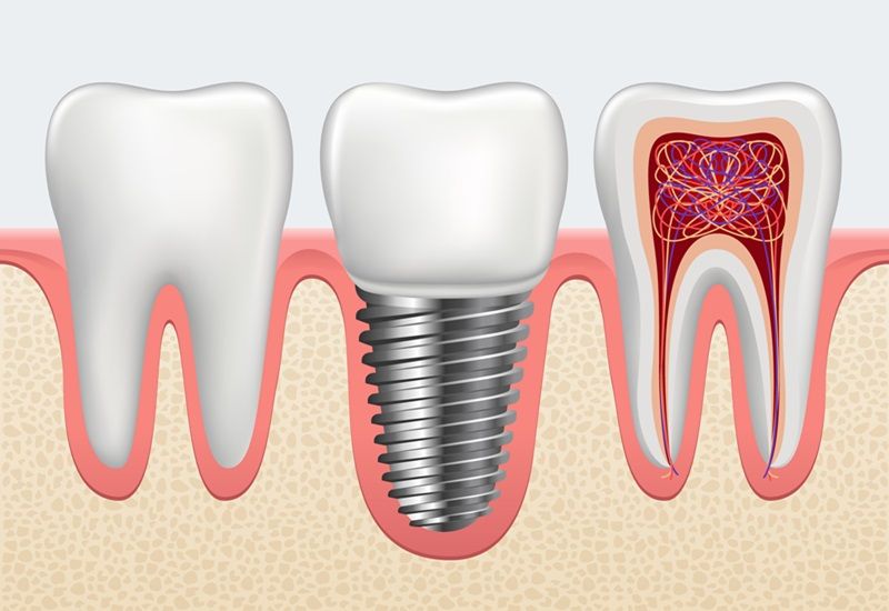 A Guide to Dental Implants and Its Different Types