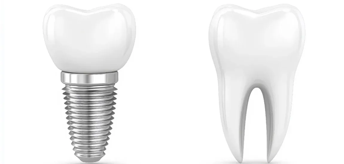 Healing After Dental Implants: Tips for a Smooth Recovery  