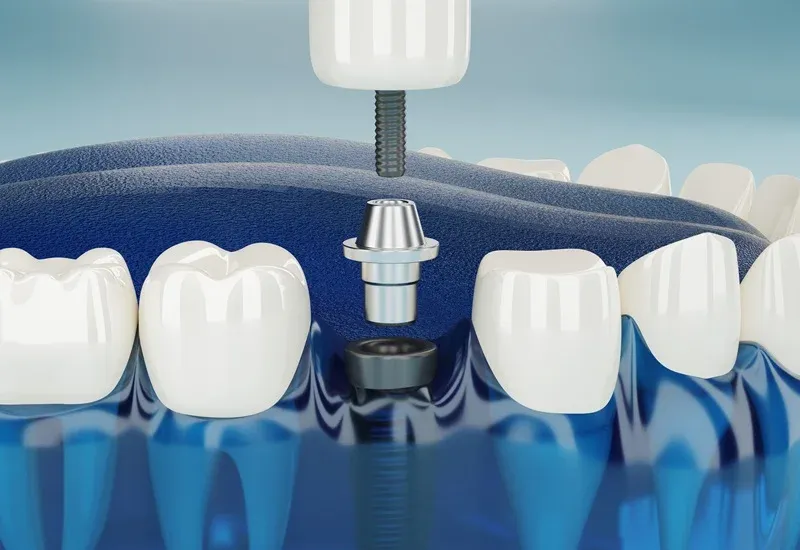 How Cosmetic Dentistry Can Save a Smile After Gum Disease