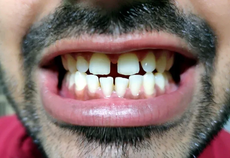 Myths and Truths About Dental Veneers Explained  