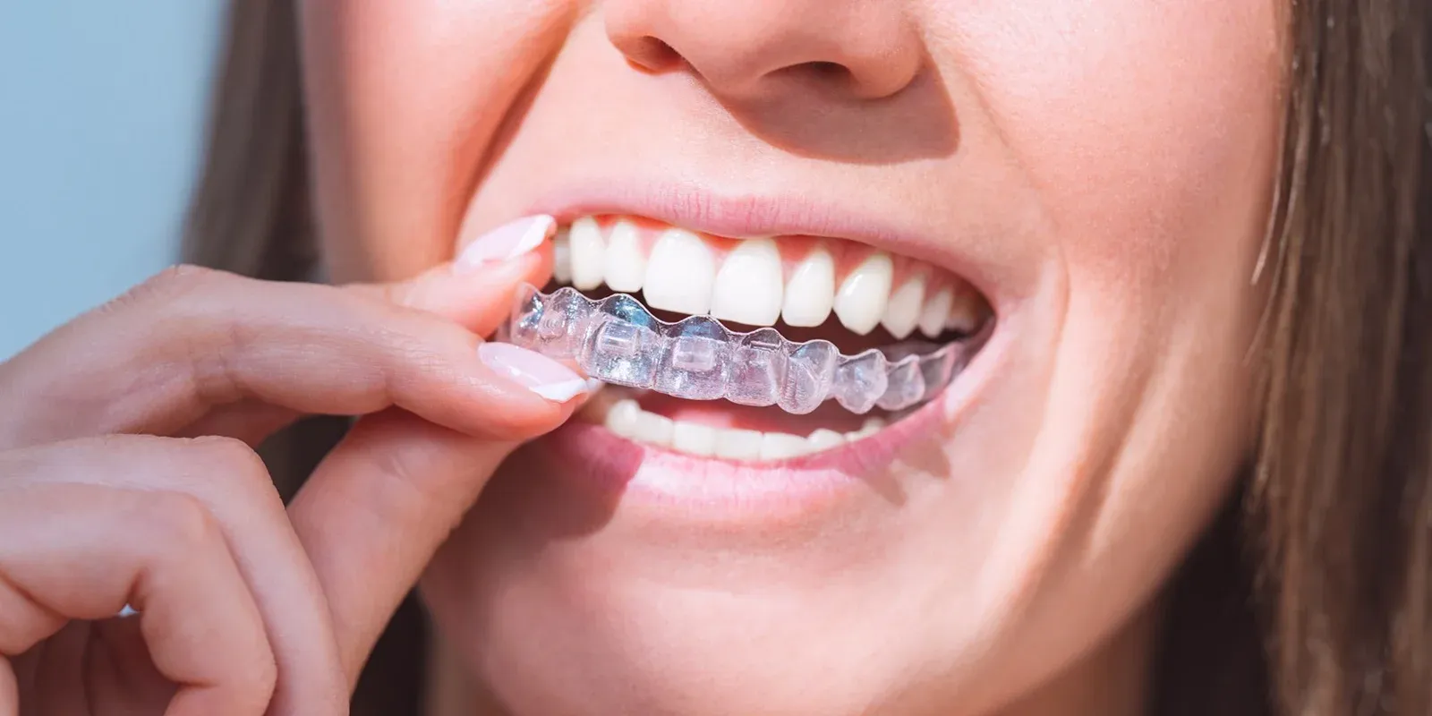 Phases of Attaining Invisalign  