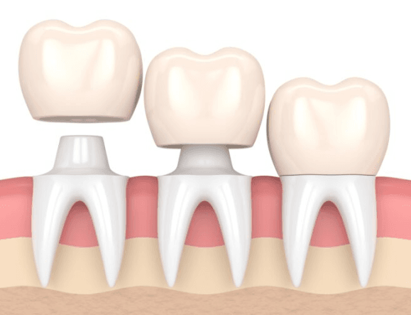 Dental Crown