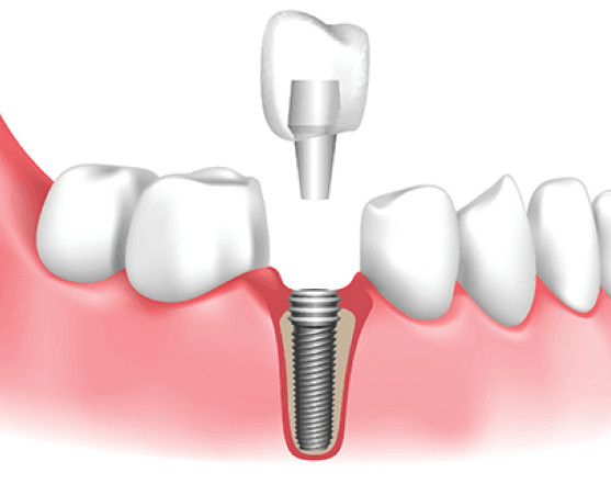 Dental Implants