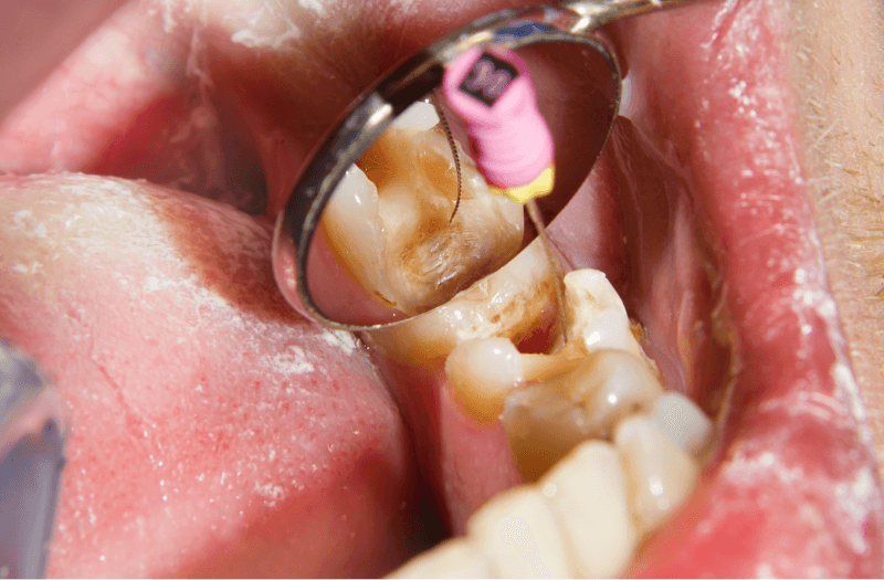 root canal